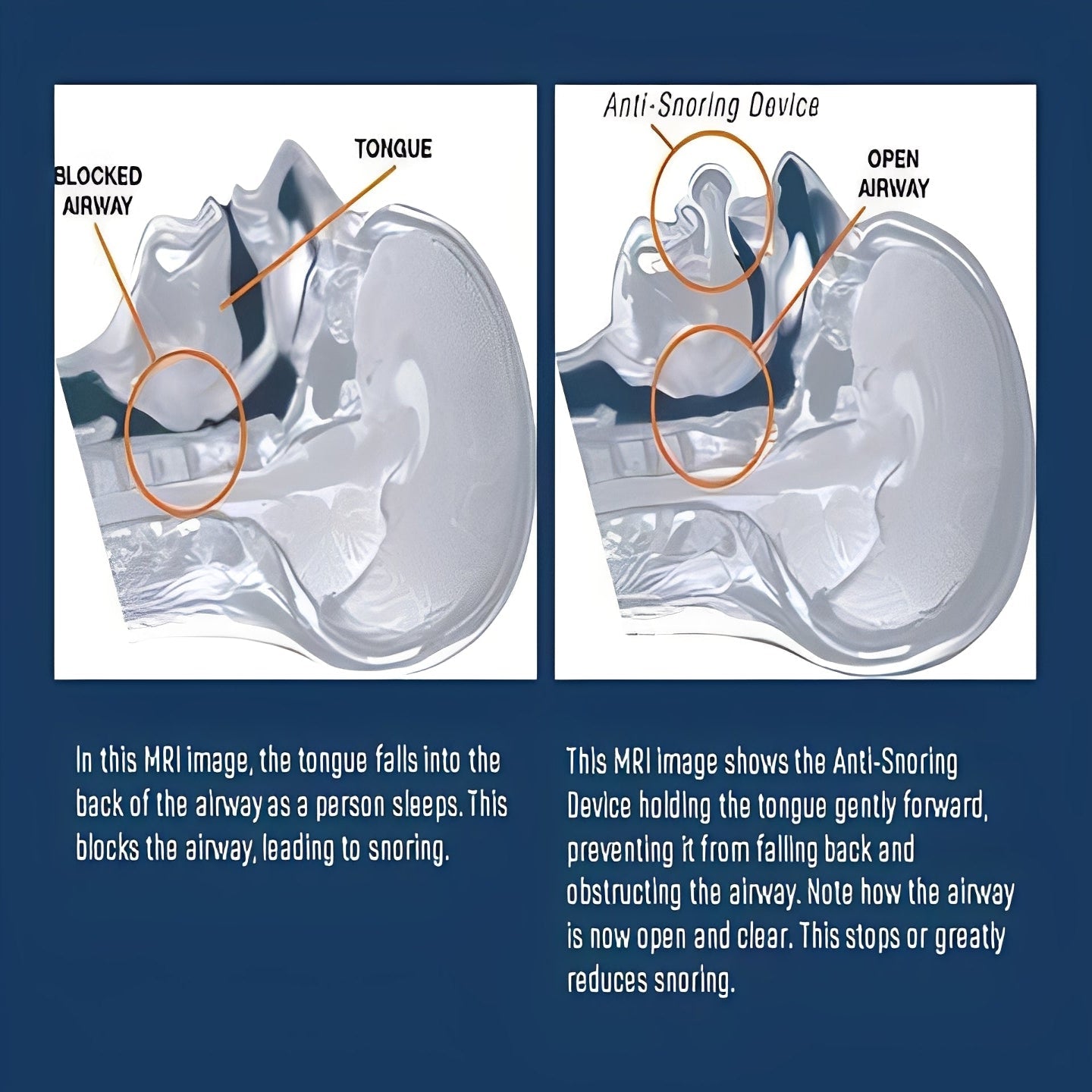 The Air-Flow Sentry: Tongue Positioning Device for Open-Airway Sleeping
